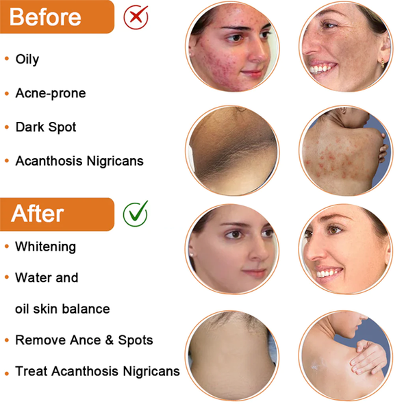 CC™ Cleansing Lotion for Acne & Spots & Acanthosis Nigricans